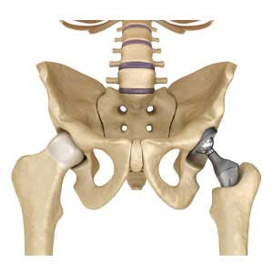 Hip Replacement & Surgeries
